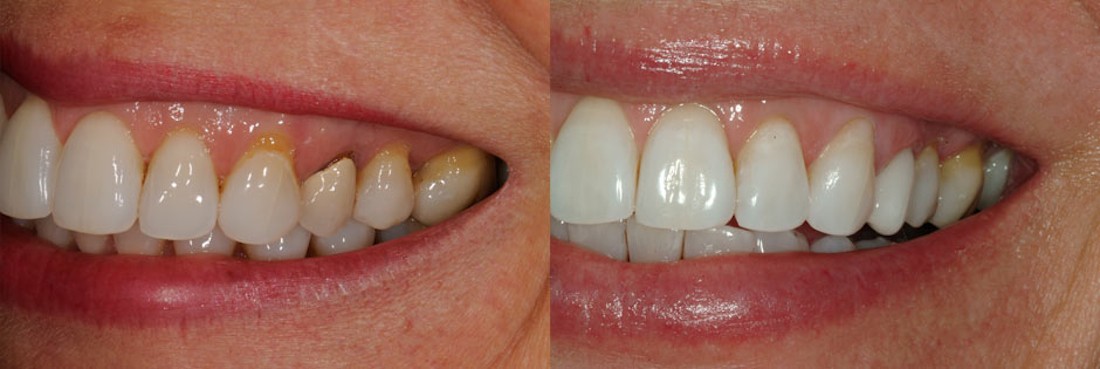 coroanele metalo-ceramice vs coroane ceramice davinci